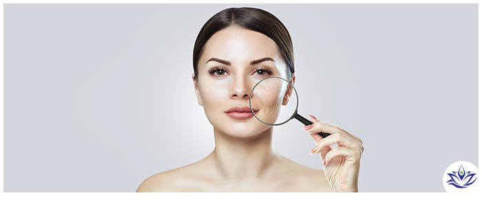 Chemical Peels for Acne Scars Near Me in Aptos, CA Chemical Peels for Acne Scars Near Me in Aptos, CA