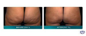 QWO for Cellulite Reduction Near Me in Aptos, CA QWO for Cellulite Reduction Near Me in Aptos, CA