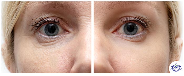 Age Spots Treatment Specialist Near Me in Aptos, CA Age Spots Treatment Specialist Near Me in Aptos, CA