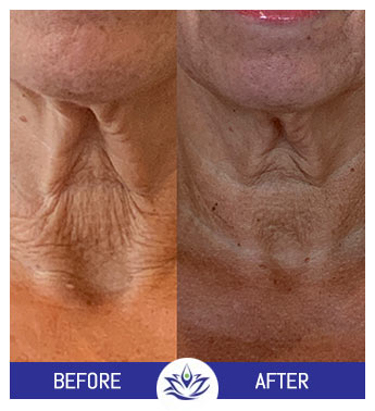 Before & After Gallery Pacific Coast Aesthetics in Santa Cruz, Aptos CA Before & After Gallery Pacific Coast Aesthetics in Santa Cruz, Aptos CA