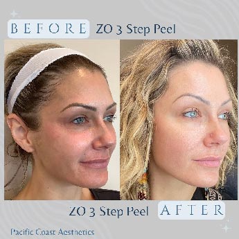 Before & After Gallery Pacific Coast Aesthetics in Santa Cruz, Aptos CA Before & After Gallery Pacific Coast Aesthetics in Santa Cruz, Aptos CA
