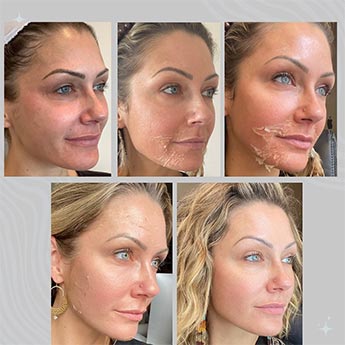 Before & After Gallery Pacific Coast Aesthetics in Santa Cruz, Aptos CA Before & After Gallery Pacific Coast Aesthetics in Santa Cruz, Aptos CA