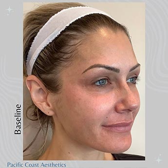 Before & After Gallery Pacific Coast Aesthetics in Santa Cruz, Aptos CA Before & After Gallery Pacific Coast Aesthetics in Santa Cruz, Aptos CA