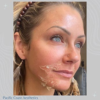 Before & After Gallery Pacific Coast Aesthetics in Santa Cruz, Aptos CA Before & After Gallery Pacific Coast Aesthetics in Santa Cruz, Aptos CA