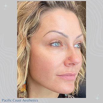 Before & After Gallery Pacific Coast Aesthetics in Aptos, CA