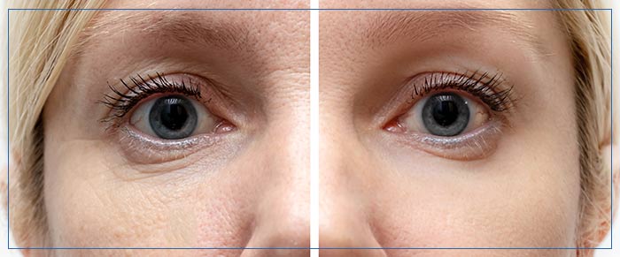 Age Spots Treatment Near Me in Santa Cruz, Aptos CA Age Spots Treatment Near Me in Santa Cruz, Aptos CA