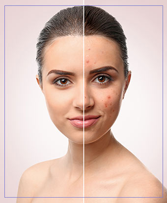 Acne Scar Resurfacing Near Me in Santa Cruz, Aptos CA