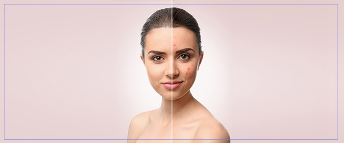 Acne Scar Resurfacing Treatment Specialist Near Me in Aptos, CA