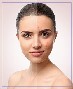 Acne Scar Resurfacing Near Me in Santa Cruz, Aptos CA