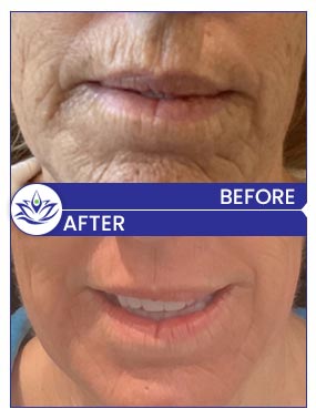 Before & After Gallery Pacific Coast Aesthetics in Santa Cruz, Aptos CA Before & After Gallery Pacific Coast Aesthetics in Santa Cruz, Aptos CA