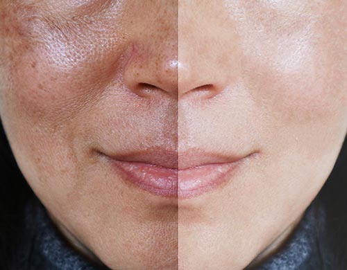 Laser Treatment Near Me in Santa Cruz, Aptos CA - Pacific Coast Aesthetics