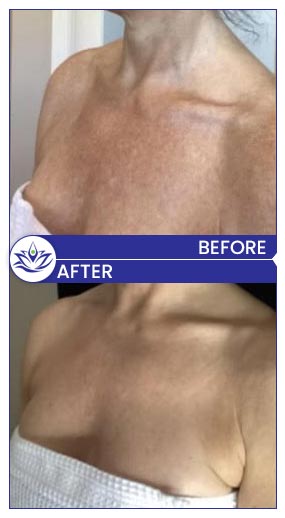 Before & After Gallery Pacific Coast Aesthetics in Santa Cruz, Aptos CA Before & After Gallery Pacific Coast Aesthetics in Santa Cruz, Aptos CA