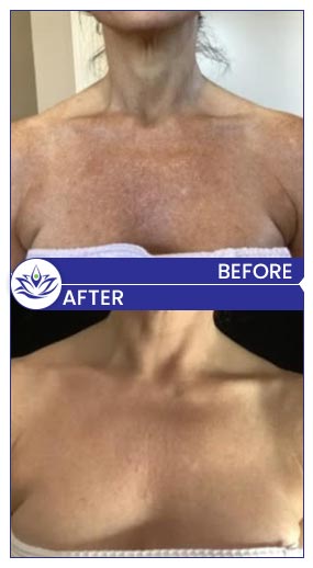 Before & After Gallery Pacific Coast Aesthetics in Santa Cruz, Aptos CA Before & After Gallery Pacific Coast Aesthetics in Santa Cruz, Aptos CA
