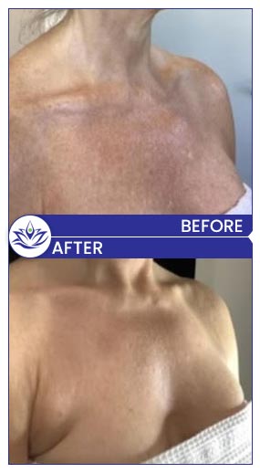 Before & After Gallery Pacific Coast Aesthetics in Santa Cruz, Aptos CA Before & After Gallery Pacific Coast Aesthetics in Santa Cruz, Aptos CA