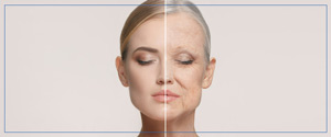 Hyperdilute Radiesse Treatment Specialist Near Me in Aptos CA Hyperdilute Radiesse Treatment Specialist Near Me in Aptos CA