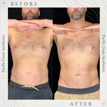 Before & After Gallery Pacific Coast Aesthetics in Santa Cruz, Aptos CA Before & After Gallery Pacific Coast Aesthetics in Santa Cruz, Aptos CA