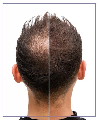 TED Hair Restoration Near Me in Santa Cruz, Aptos CA