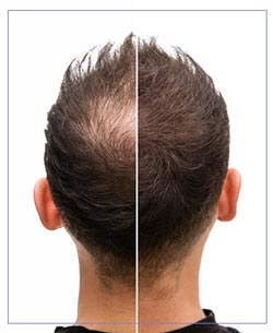 TED Hair Restoration Near Me in Santa Cruz, Aptos CA