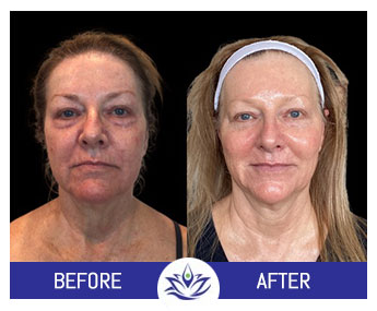 Before & After Gallery Pacific Coast Aesthetics in Santa Cruz, Aptos CA Before & After Gallery Pacific Coast Aesthetics in Santa Cruz, Aptos CA