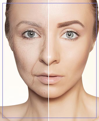 Hyperdilute Radiesse Treatment in Aptos, CA