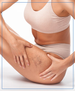 ClearV Treatment by Sciton Near Me in Santa Cruz, Aptos CA