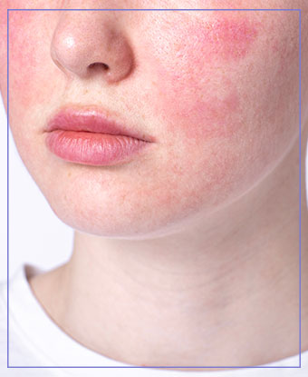 TRL Single Spot Lesion Removal Near Me in Santa Cruz, Aptos CA